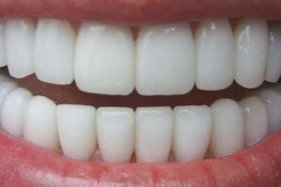 Clareamento nos dentes rápido e sem dor